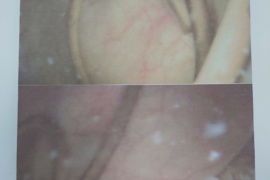 На Прикарпатті жінці забули витягнути катетер після операції: вона дізналася про це через півтори роки