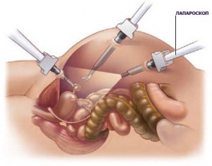 laparoscopy