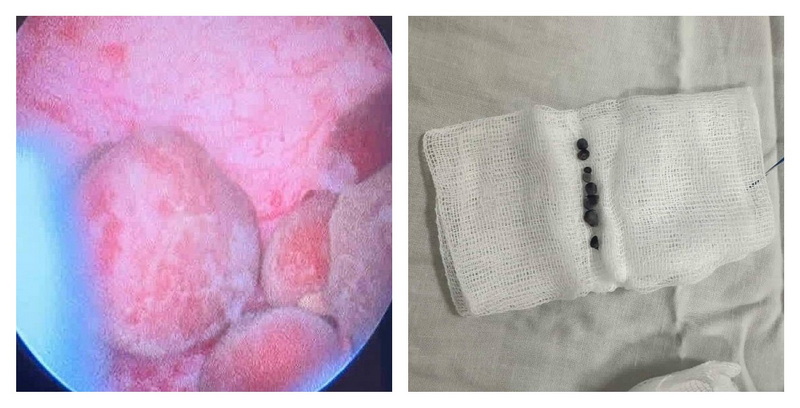 операція-нирки