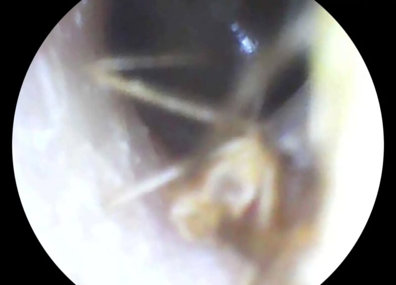 У франківській лікарні у вусі пацієнтки виявили павука